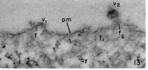 Leukemia tumor cell showing accumulated filamentous material