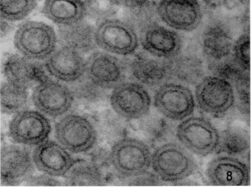 Lymphoblastic lymphoma from subcutaneous site of implantation