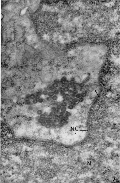 Lymphoblastic lymphoma from subcutaneous site of implantation