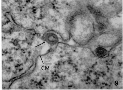 Lymphoblastic lymphoma involving mesentery