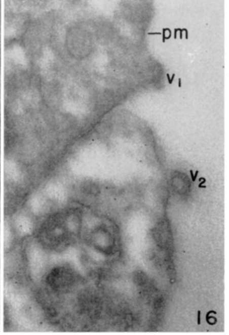Periphery of leukemia tumor cell showing infoldings of plasma membrane