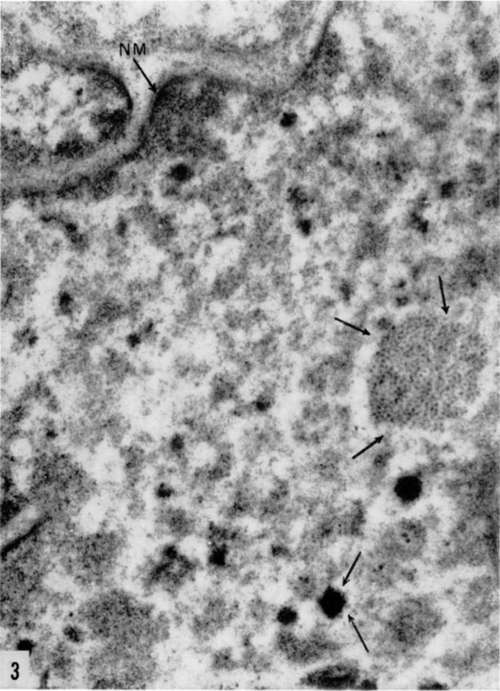 Portion of nucleus of human breast carcinoma cell