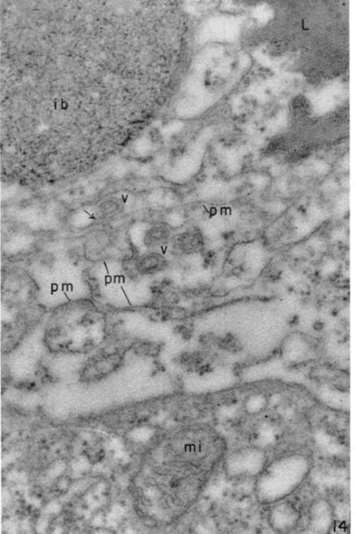 Region between two leukemia tumor cells