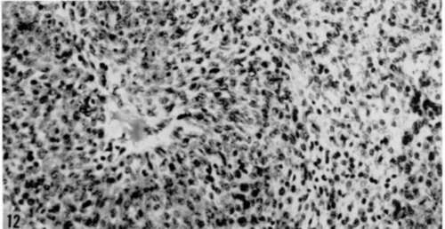 Section of tumor that grew subeutaneously over lumbar spine