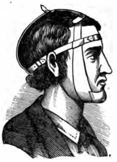 Fig. 368. Bandage For Fracture of the Lower Jaw.