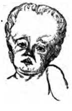 Fig. 354. Front View of Head of Hydrocepalus Child.