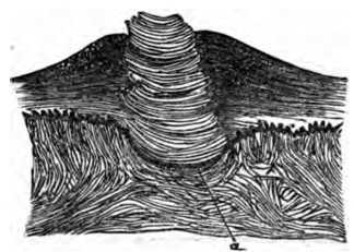Fig. 404. Hard Corns.