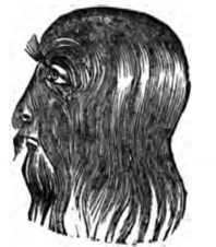 Fig. 348. Hirsutes or Overgrowth Of The Hair.