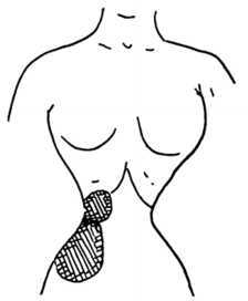 Fig. 295. Liver Almost Divided in Two.