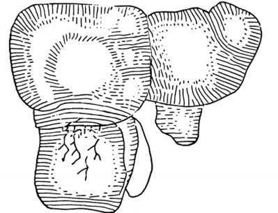 Fig. 293. Liver Showing Effects of Compression.