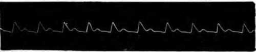 Fig. 315. Pulse of a Healthy Person.