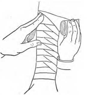 Fig. 366. Roller Bandage on Shin.