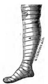 Fig. 367. Roller Bandage Properly Applied To Leg.
