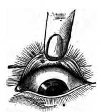 Fig. 444. Rolling Eye Lid Over Pencil.