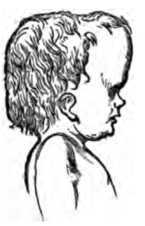 Fig. 352. Side View of Head of Hydrocepalus Child.