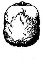 Fig. 353. Vertex View of Head of Hydrocepalus Child.