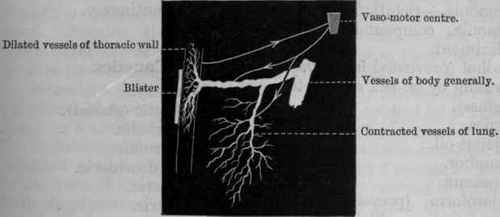Fig. 123.   Diagram to explain the action of counter irritation. A blister or other counter irritant is shown applied to the chest wall. The stimulus which it causes is transmitted up the afferent nerves to the vaso motor centre; it is thence reflected down the vaso motor nerves to the pulmonary vessels, causing them to contract, while it is reflected down vaso dilating fibres to the vessels of the thoracic wall and probably of other parts of the body also, causing them to dilate, and thus lessening the pulmonary congestion by withdrawing blood from the lungs.