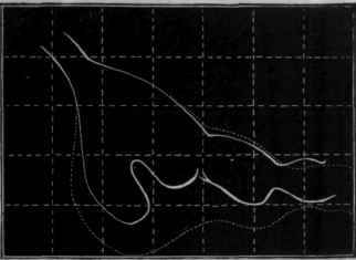 Fig. 128.   Action of tartar emetic on the stomach in producing active contraction of an antiperistaltic character. The dotted line shows the shape of the stomach at rest.