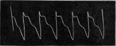 Fig. 173.   Normal pulse tracing of a patient suffering from aortic regurgitation and angina pectoris.