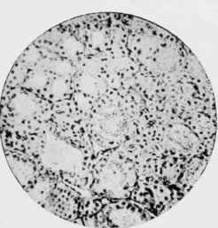 Thyroid Gland of Wild Rat from same source as Fig. 29 after feeding for ten weeks on a bread and milk diet.