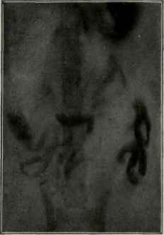 Appearance of food in the intestines 5 3/4 hours after eating.