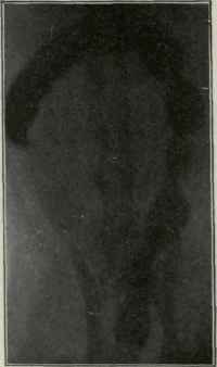 Radiograph showing the region of tonic constrictions (descending colon).