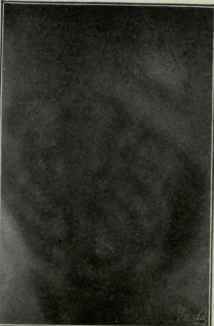 Radiographs showing that after a large nutrient enema.