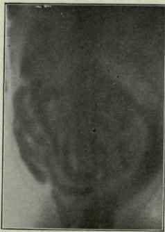 The Question Of Antiperistalsis 25