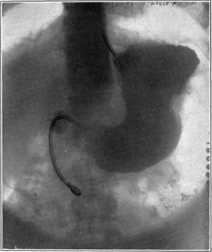 Patient L. K. after the ingestion of a bismuth mixture into the stomach.