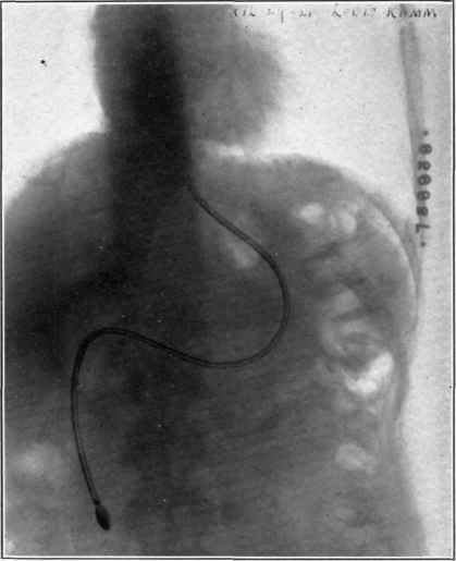 Patient L. K. with duodenal tube in the duodenum with empty stomach.