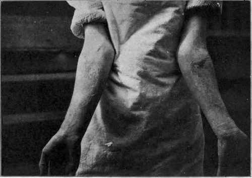 The Remarkable Bilateral Symmetry Of The Skin Lesions Of Pellagra