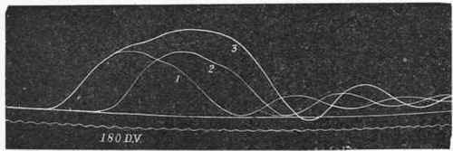 Pendulum Myograph tracings showing summation.