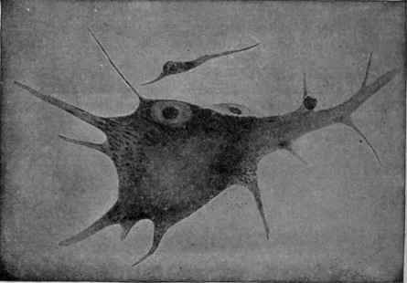 Cell from a Case of Central Neuritis, showing Axonal Alteration