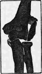 Fig. 111.   Fracture of condyle of humerus. Case 497.