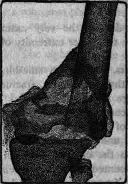 Fig. 112.   Smash of extremity of femur. Case 106.