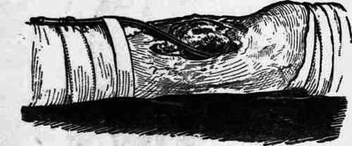 Fig. 53.   Compound fracture of tibia with the opening of the wound on the anterior aspect of the limb; in the seat of fracture is a tube open at the end.