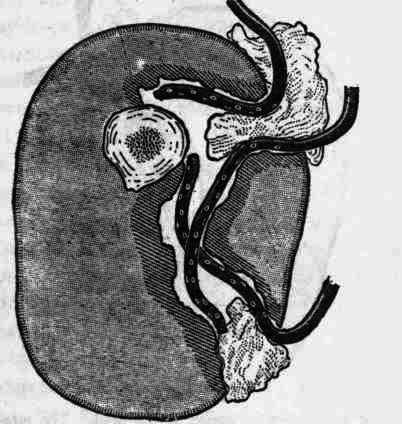 Fig. 55.   Irregular wound of the thigh. Two tubes are placed in the wound anteriorly and one posteriorly. These tubes are applied to the surface of the tissues. They are kept apart by gauze packed between them in the opening of the wound.