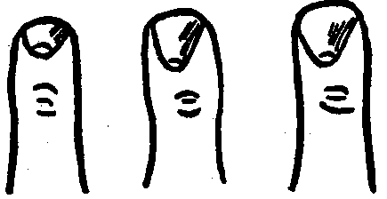 Shell Shaped Nails. Strong Tendency Towards Paralysis.