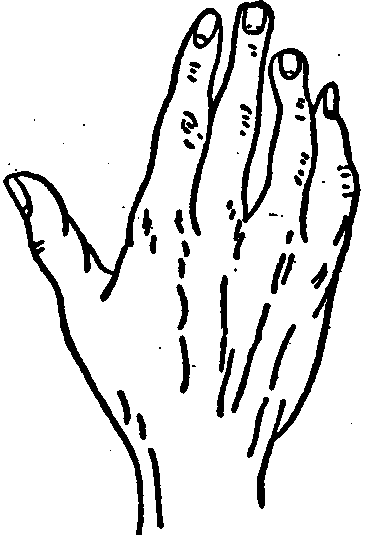 The Mixed Hand.