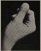 CLUBBED THUMB (CALLED THE MURDERER'S THUMB)