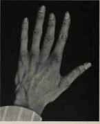 . FINGER OF SATURN DEFICIENT