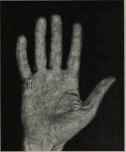 MERCURIAN DOCTORS' HAND