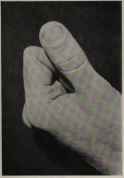 PADDLE SHAPED THUMB