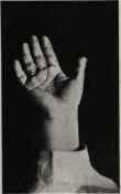 THICK THIRD PHALANX OF JUPITER FINGER