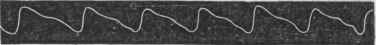 Trace of the Radial Pulse, taken by the Sphygmograph.