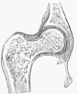 Fig. 2.   A section of the hip joint taken through the acetabulum and the middle of the head and neck of the thigh bone.   L. T. Ligamentum teres, or round ligament.
